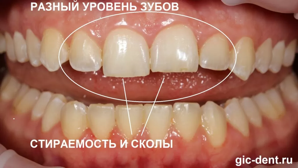 2 - передняя группа зубов, два центральных резца патологическая стираемость, есть сколы.jpg